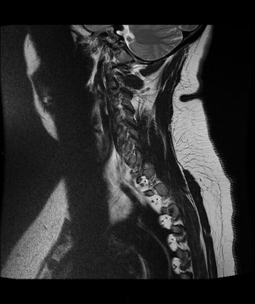 File:Cervical disc prolapse (Radiopaedia 80258-93598 Sagittal T2 15).jpg