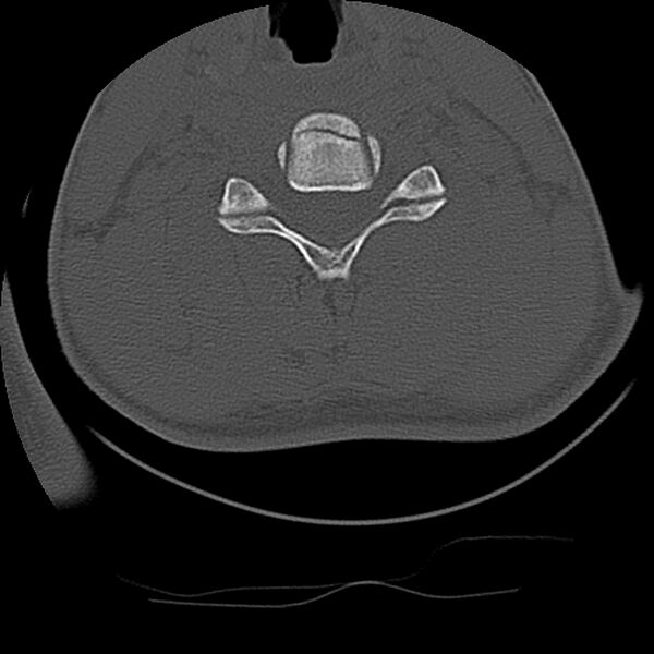 File:Cervical flexion teardrop fracture with cord hemorrhage (Radiopaedia 32497-33454 Axial bone window 54).jpg
