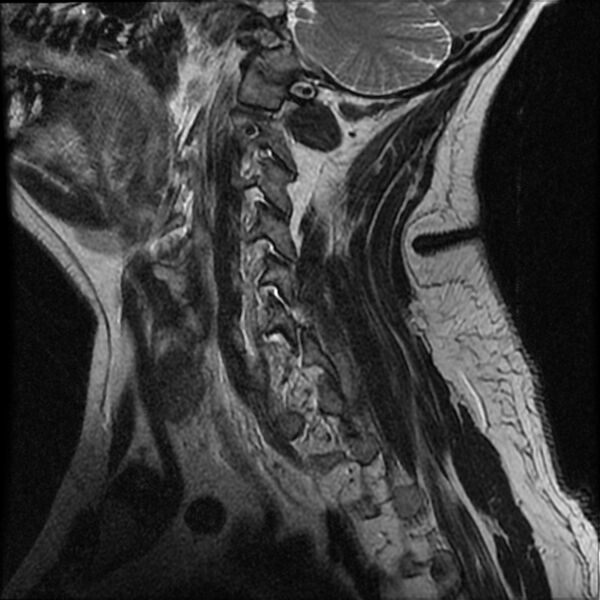 File:Cervical fracture and dislocation with locked facet (Radiopaedia 31837-32781 Sagittal T2 1).jpg