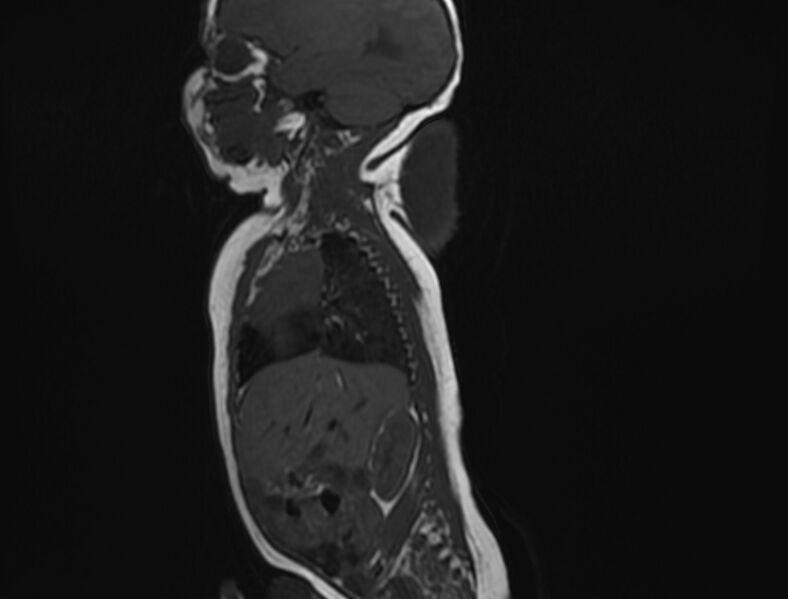 File:Cervical myelomeningocele (Radiopaedia 69569-79479 Sagittal T1 2).jpg