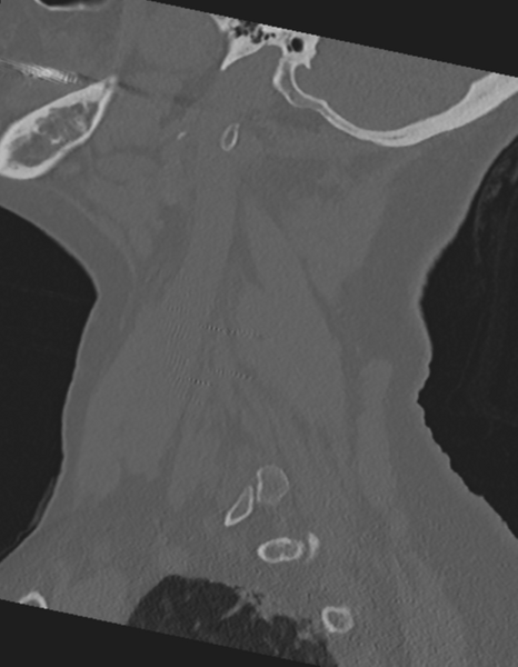 File:Cervical spine ACDF loosening (Radiopaedia 48998-54071 Sagittal bone window 21).png