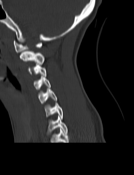 File:Cervical spine posterior ligamentous complex rupture (Radiopaedia 63486-72101 Sagittal bone window 18).jpg