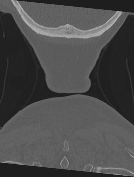 File:Cervical spondylolysis (Radiopaedia 49616-54811 Coronal bone window 67).png