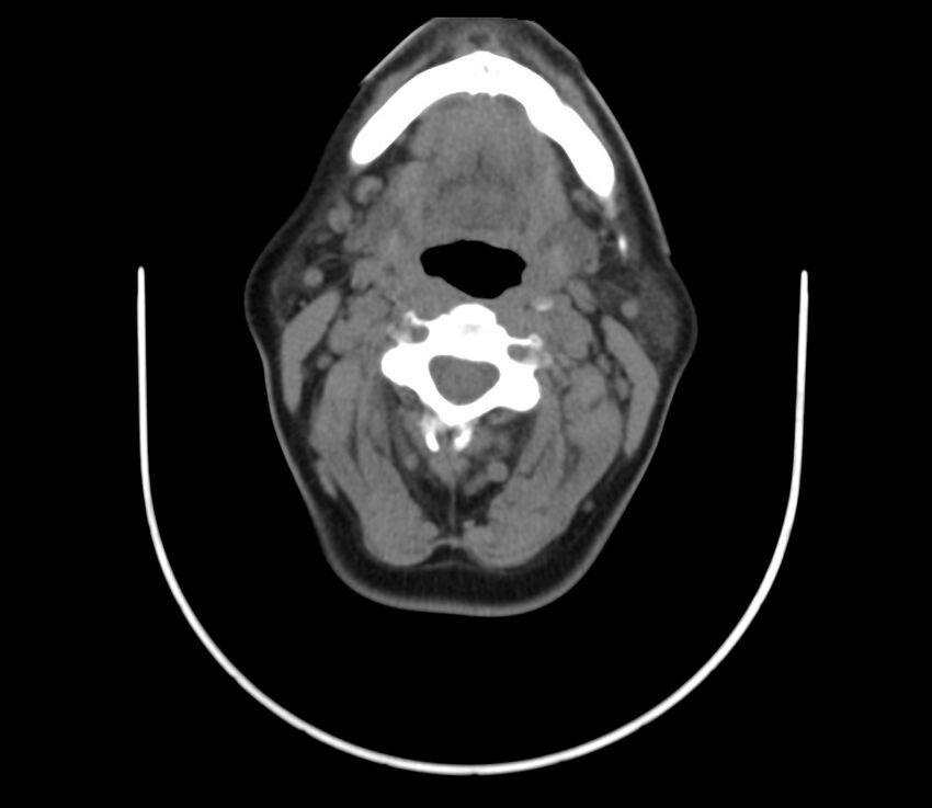 Cervical venous malformation (Radiopaedia 22653-22672 Axial non-contrast 27).jpg