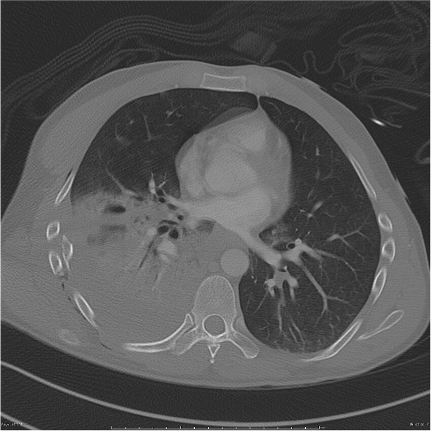 Chest and abdomen multi-trauma (Radiopaedia 26294-26425 bone window 62).jpg