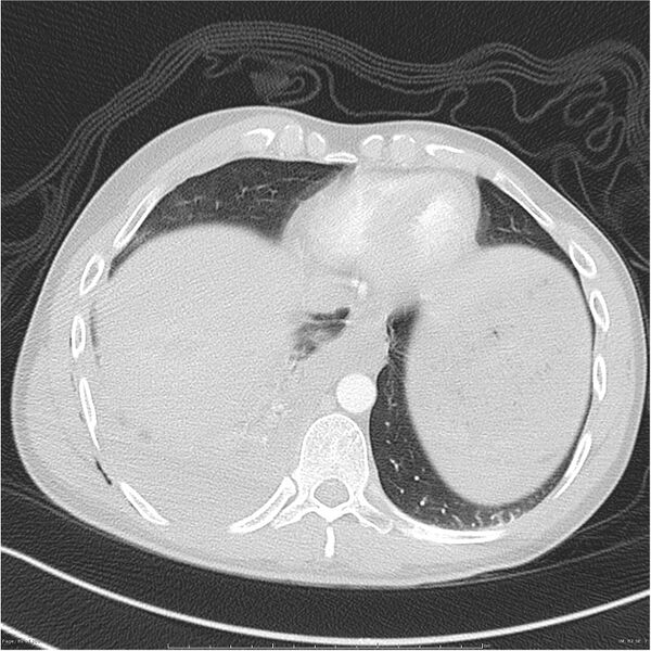 File:Chest and abdomen multi-trauma (Radiopaedia 26294-26425 lung window 82).jpg