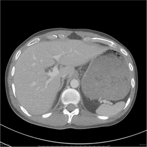 File:Chest and abdomen multi-trauma (Radiopaedia 26294-26426 bone window 21).jpg