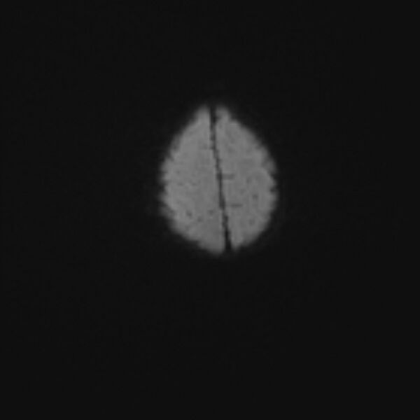 File:Chiari III malformation with occipital encephalocele (Radiopaedia 79446-92559 Axial DWI 38).jpg