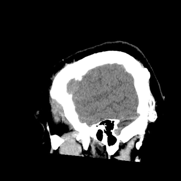 File:Chiasmatic-hypothalamic juvenile pilocytic astrocytoma (Radiopaedia 78533-91237 B 52).jpg