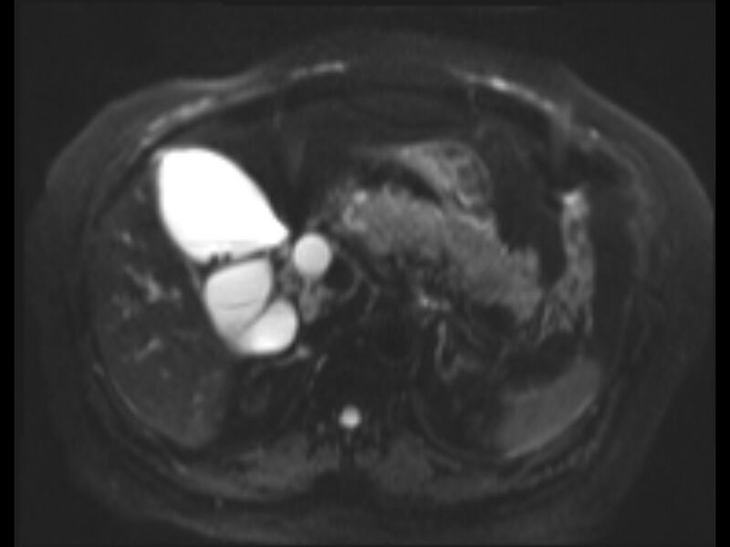 File:Choledocholithiasis causing intrahepatic biliary duct dilation (Radiopaedia 39908-42369 Axial T2 SPAIR 17).jpg