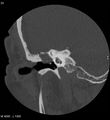 Cholesteatoma (Radiopaedia 5467-7197 Coronal bone window 8).jpg
