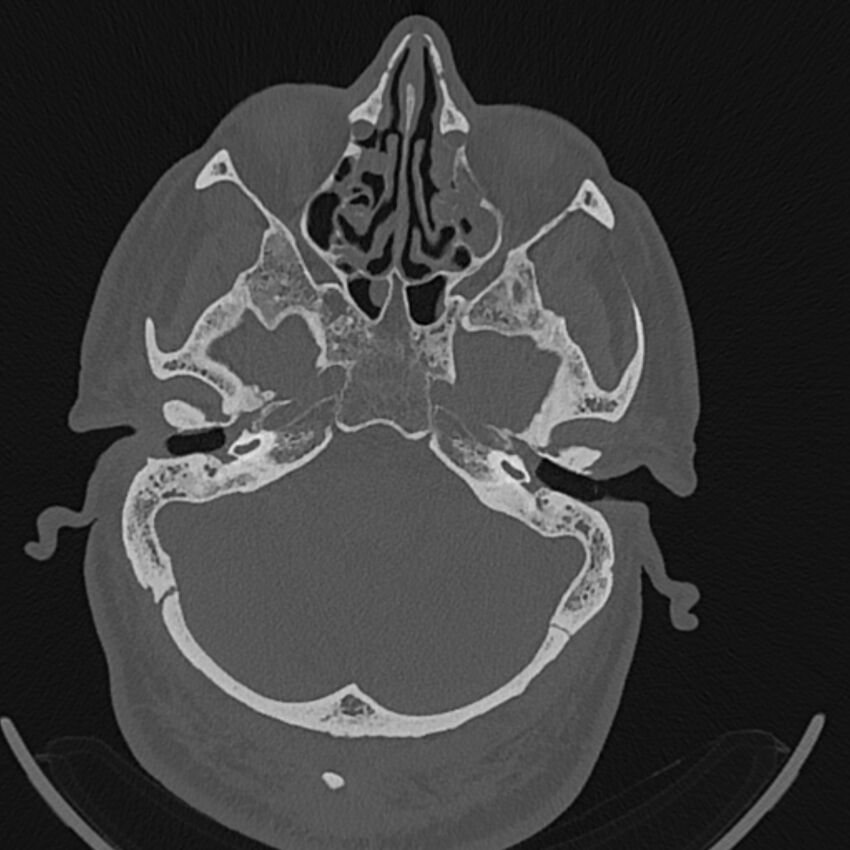 Cholesteatoma (Radiopaedia 68176-77673 Axial bone window 34).jpg