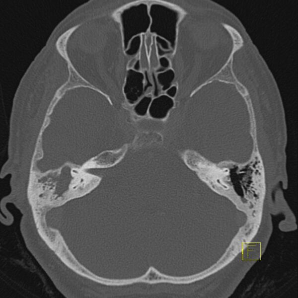 File:Cholesteatomatous chronic otitis (Radiopaedia 14993-14911 Axial bone window 5).JPEG