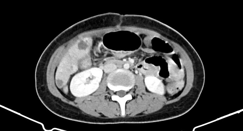 File:Choriocarcinoma liver metastases (Radiopaedia 74768-85766 A 108).jpg