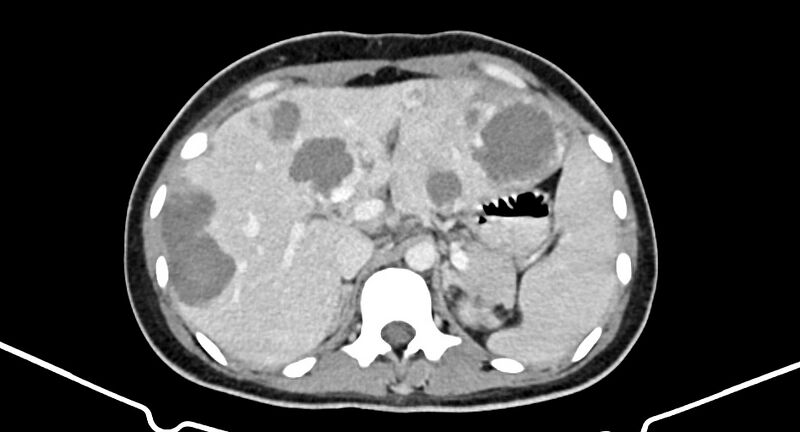 File:Choriocarcinoma liver metastases (Radiopaedia 74768-85766 A 66).jpg