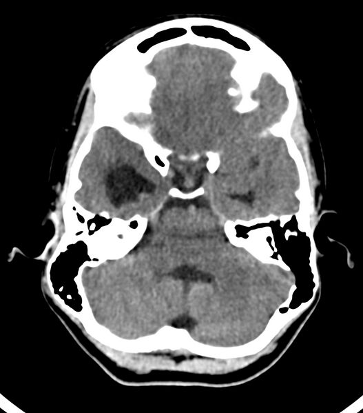 File:Choroid plexus carcinoma (Radiopaedia 91013-108552 Axial non-contrast 18).jpg