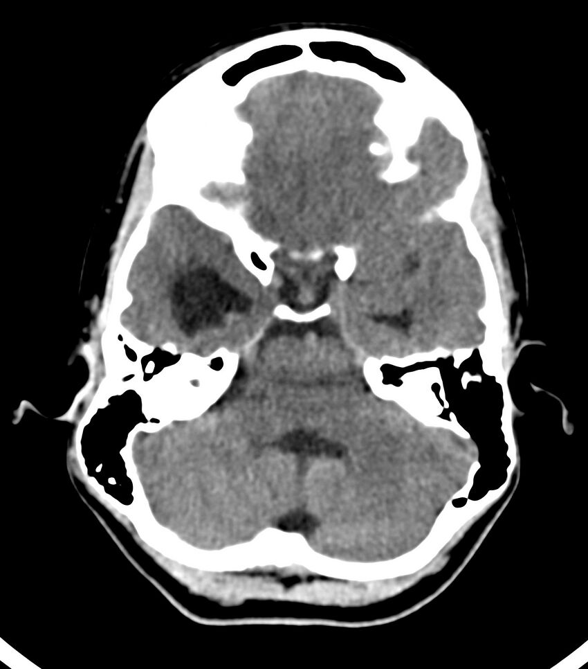 Choroid plexus carcinoma (Radiopaedia 91013-108552 Axial non-contrast 18).jpg