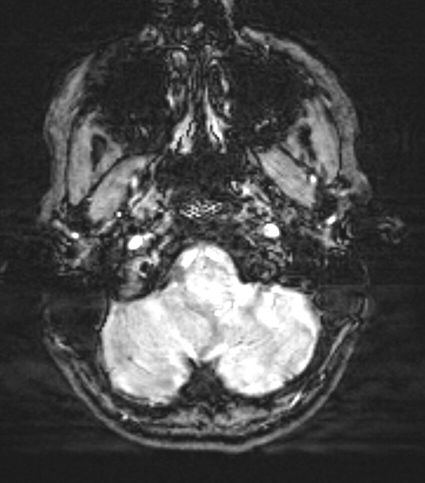 Choroid plexus carcinoma (Radiopaedia 91013-108553 Axial SWI 13).jpg
