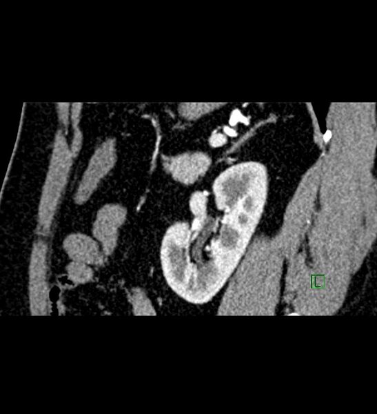 File:Chromophobe renal cell carcinoma (Radiopaedia 84286-99573 F 50).jpg