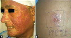 (a) Chronic actinic dermatitis (actinic reticuloid) due to PPD. (b) Patch test shows 3+ reaction to PPD