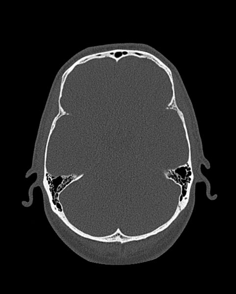 File:Chronic maxillary sinusitis caused by a foreign body (Radiopaedia 58521-65676 Axial bone window 296).jpg