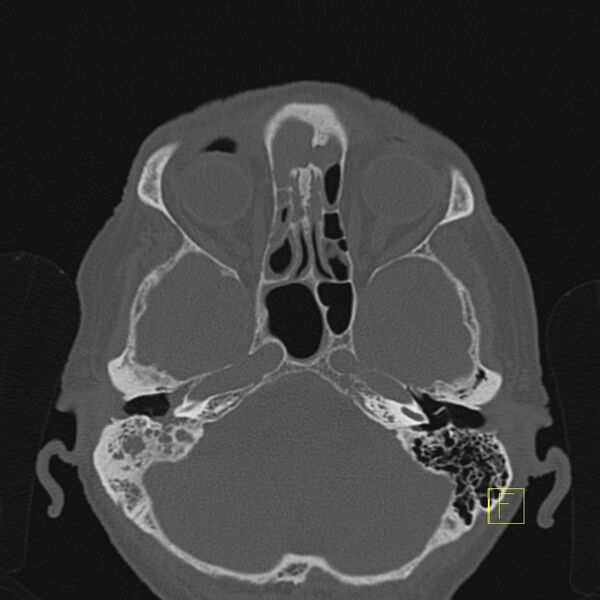 File:Chronic otitis media (Radiopaedia 14994-14912 Axial bone window 14).JPEG