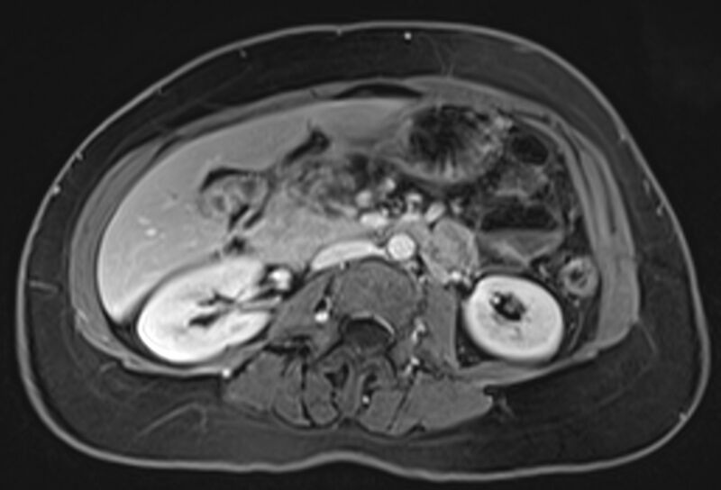 File:Chronic pancreatitis - pancreatic duct calculi (Radiopaedia 71818-82250 Axial T1 C+ fat sat 39).jpg