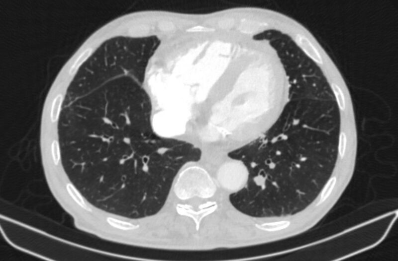 File:Chronic pulmonary embolism (Radiopaedia 91241-108843 Axial lung window 66).jpg