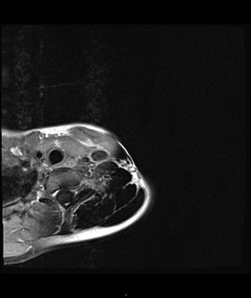 File:Chronic reactive multifocal osteomyelitis (CRMO) - clavicle (Radiopaedia 56406-63071 Axial T1 C+ fat sat 2).jpg