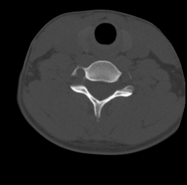 File:Clay-shoveler fracture (Radiopaedia 22568-22590 Axial bone window 53).jpg