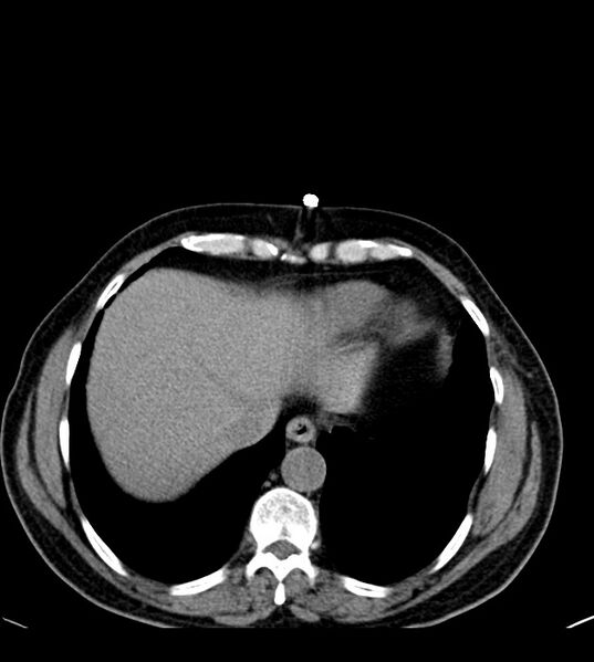 File:Clear cell renal cell carcinoma (Radiopaedia 85006-100539 Axial non-contrast 15).jpg