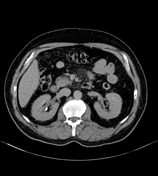 File:Clear cell renal cell carcinoma (Radiopaedia 85006-100539 H 14).jpg