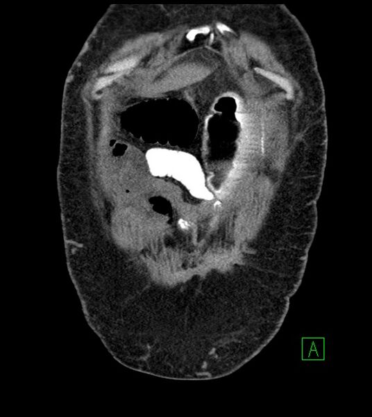 File:Closed-loop small bowel obstruction-internal hernia (Radiopaedia 78439-91096 Coronal non-contrast 20).jpg