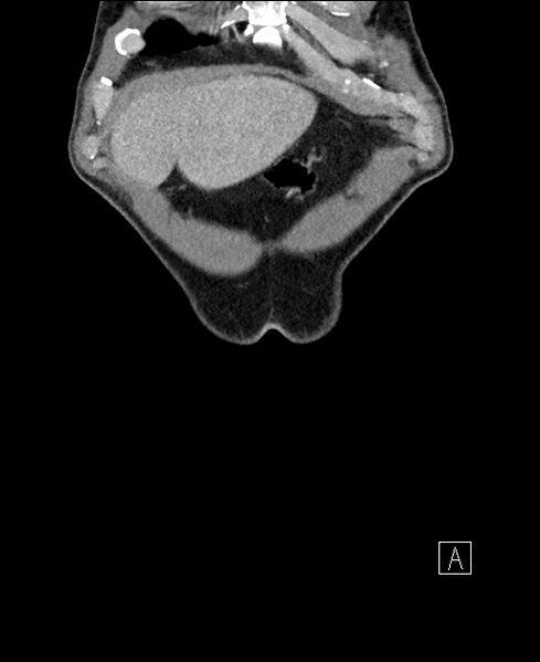 File:Closed loop small bowel obstruction - internal hernia (Radiopaedia 57806-64778 A 9).jpg
