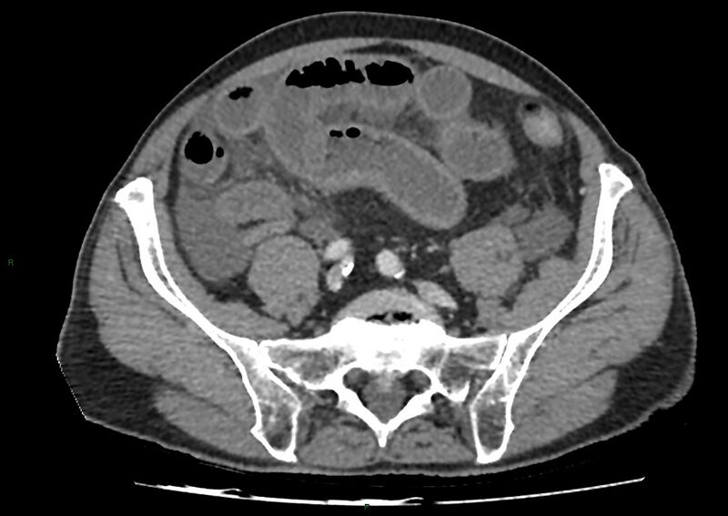 File:Closed loop small bowel obstruction with ischemia (Radiopaedia 84180-99456 A 86).jpg