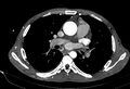 Coarctation of aorta with aortic valve stenosis (Radiopaedia 70463-80574 A 90).jpg