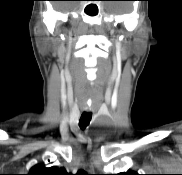 File:Colloid cyst of thyroid (Radiopaedia 22897-22923 Coronal C+ delayed 30).jpg