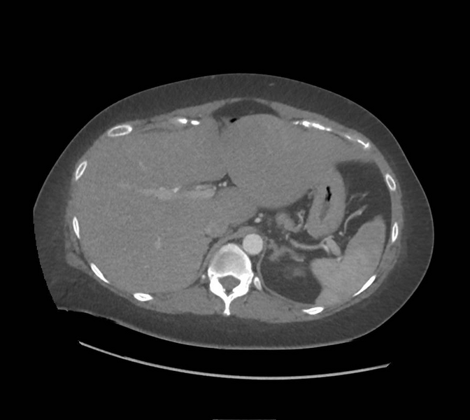 File:Colonic pseudo-obstruction (Radiopaedia 79752-92980 A 45).png