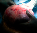 Mucinous borderline tumor: Extraction of the abdominopelvic mass