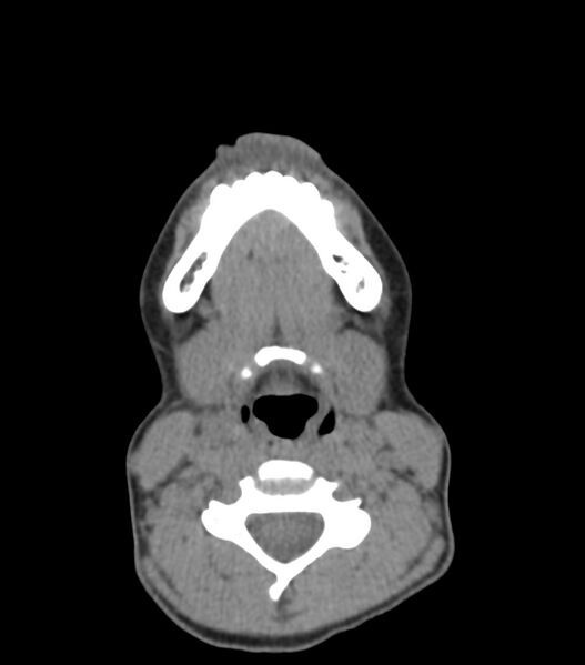 File:Nasoorbitoethmoid fracture (Radiopaedia 90044-107205 Axial non-contrast 45).jpg