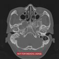 Nasopharyngeal carcinoma recurrence - skull base destruction (Radiopaedia 29107-29490 Axial bone window 88).jpg