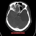 Nasopharyngeal carcinoma recurrence - skull base destruction (Radiopaedia 29107-29491 A 1).jpg