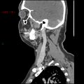 Nasopharyngeal lymphoma (Radiopaedia 54235-60433 B 9).jpg