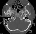 Necrotizing otitis externa (Radiopaedia 19938-19971 Axial bone window 2).jpg
