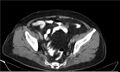 Necrotizing pancreatitis (Radiopaedia 20595-20495 A 38).jpg