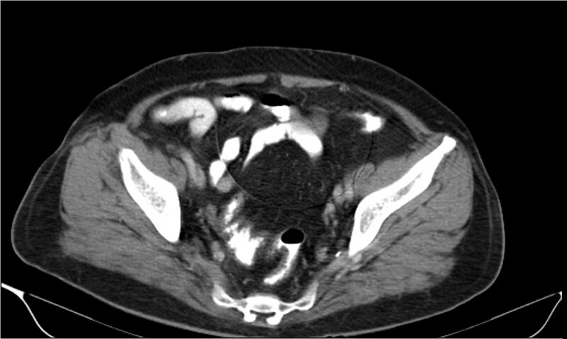 File:Necrotizing pancreatitis (Radiopaedia 20595-20495 A 38).jpg