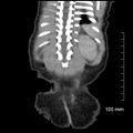 Neonatal neuroblastoma (Radiopaedia 56651-63438 Coronal non-contrast 44).jpg