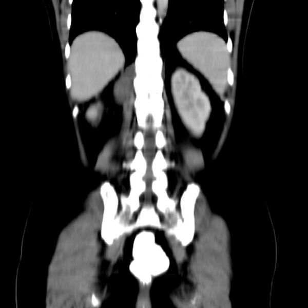 File:Neurofibroma - spine (Radiopaedia 27891-28125 B 23).jpg