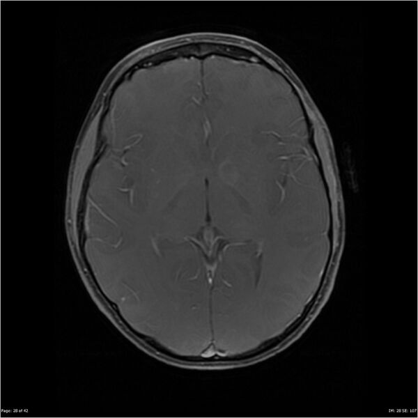 File:Neurofibromatosis type 1 (Radiopaedia 22541-22564 Axial T1 C+ fat sat 28).jpg
