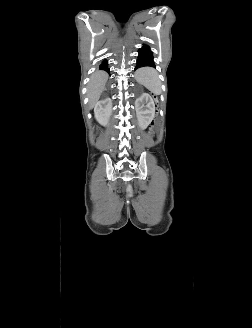 Neurofibromatosis type 1 (Radiopaedia 49538-54733 B 6).jpg